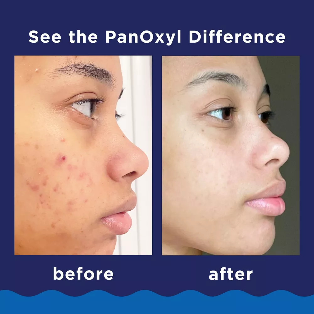 Clear Breakouts Fast with PanOxyl Acne Foaming Wash 10% BP - Image 7